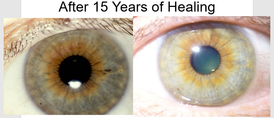 My iris Right change