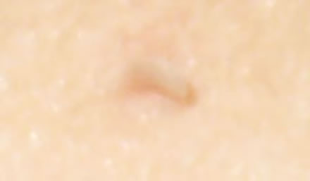 Skin tag 2
